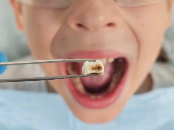 Best Emergency Wisdom Teeth Removal in Roberts, WI